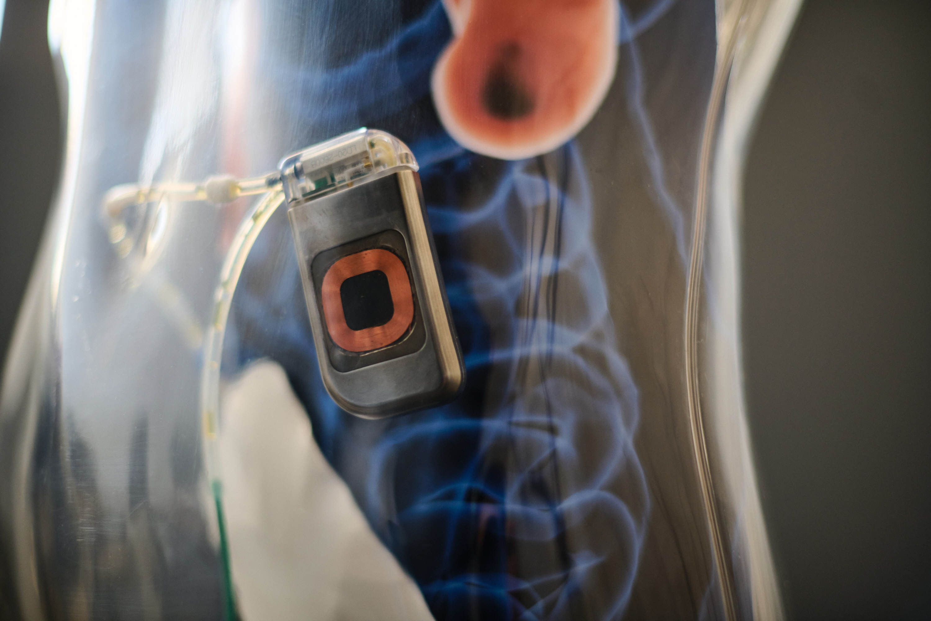 Paragate Medical, innovative company developing device for heart failure epidemic management. Haifa, Israel. For Paragate Medical